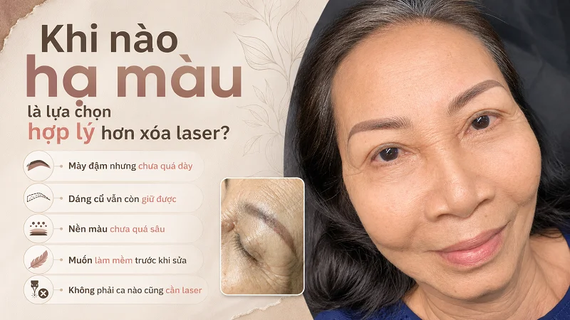 Khi nào hạ màu là lựa chọn hợp lý hơn xóa laser? Khi nào hạ màu là lựa chọn hợp lý hơn xóa laser?