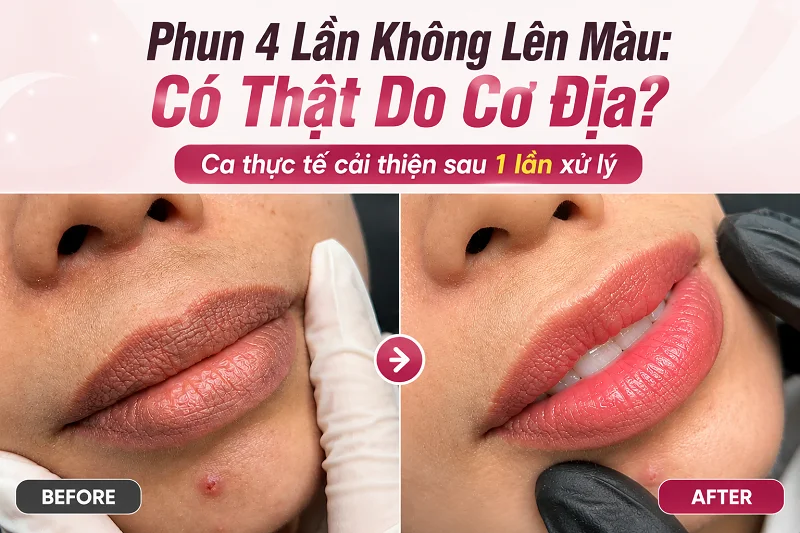 Chỉ 1 Lần Xử Lý, Môi Từng Phun 4 Lần Do 