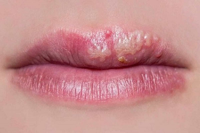 Phun môi Ombre không chất lượng hậu quả khó lường!